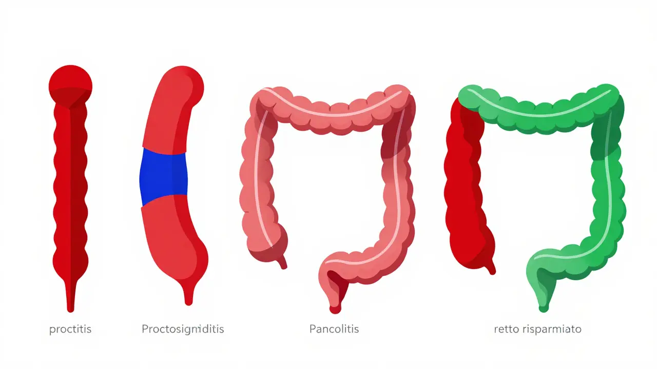 Five sections of the colon illustrated with colors and shapes to show disease extent.